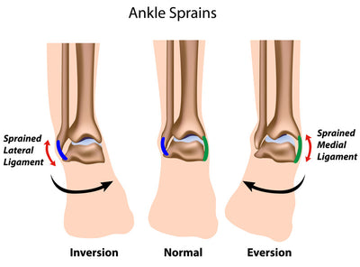Ankle Sprain: Signs - Symptoms - Prevention and Treatment